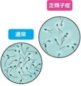 乏精子症.jpg