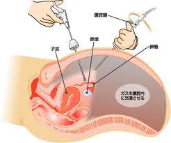 腹腔鏡検査.jpg